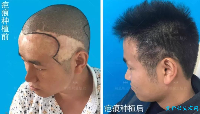 疤痕植发